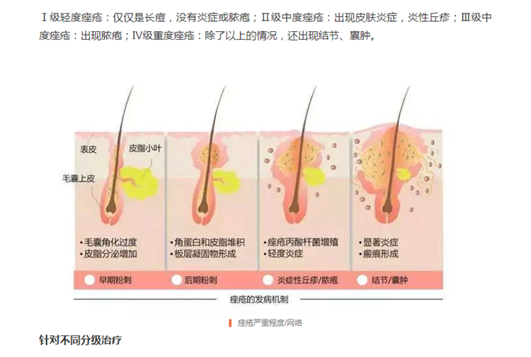请查收治疗青春痘的权威手册