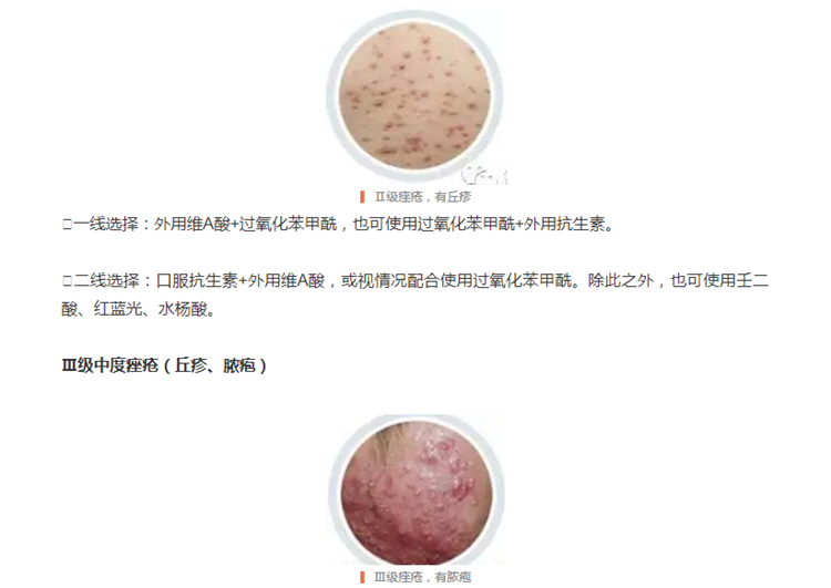 请查收治疗青春痘的权威手册