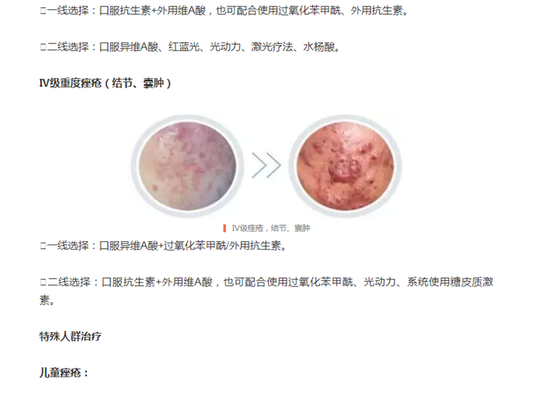 请查收治疗青春痘的权威手册