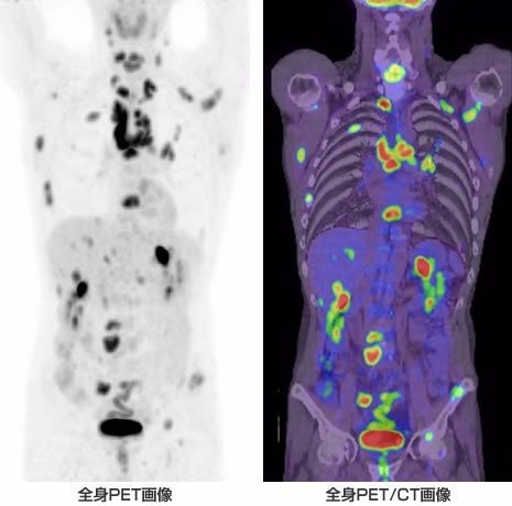 癌症筛查方法大全 癌症筛查方法大全