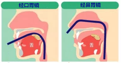 日本鼻胃镜—真正的无痛胃镜 日本鼻胃镜—真正的无痛胃镜