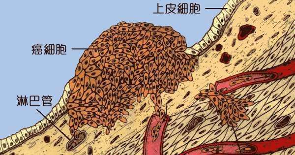解读:癌细胞为什么能够四处转移、生根? 解读:癌细胞为什么能够四处转移、生根?
