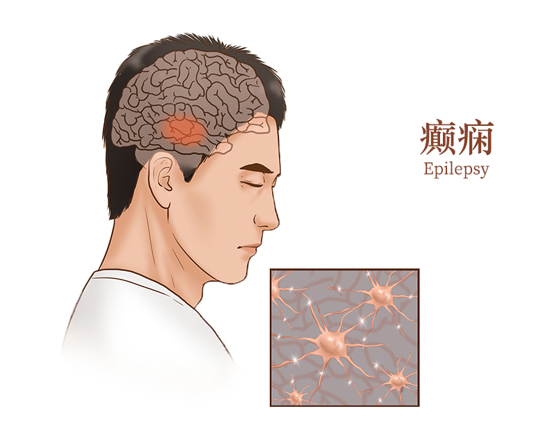 丙戊酸治疗药物监测（TDM）的意义和方法综述