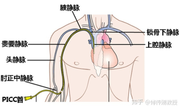 大众科普| 教您PICC如何居家护理! 大众科普| 教您PICC如何居家护理!