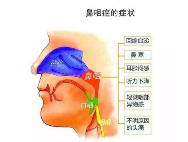 大众科普|鼻咽癌小科普! 大众科普|鼻咽癌小科普!