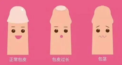 大众科普|什么是包皮过长?要不要手术? 大众科普|什么是包皮过长?要不要手术?