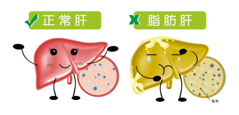 大众科普|一文了解脂肪肝 大众科普|一文了解脂肪肝