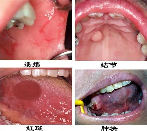 大众科普|了解口腔报警信号,远离口腔癌 大众科普|了解口腔报警信号,远离口腔癌