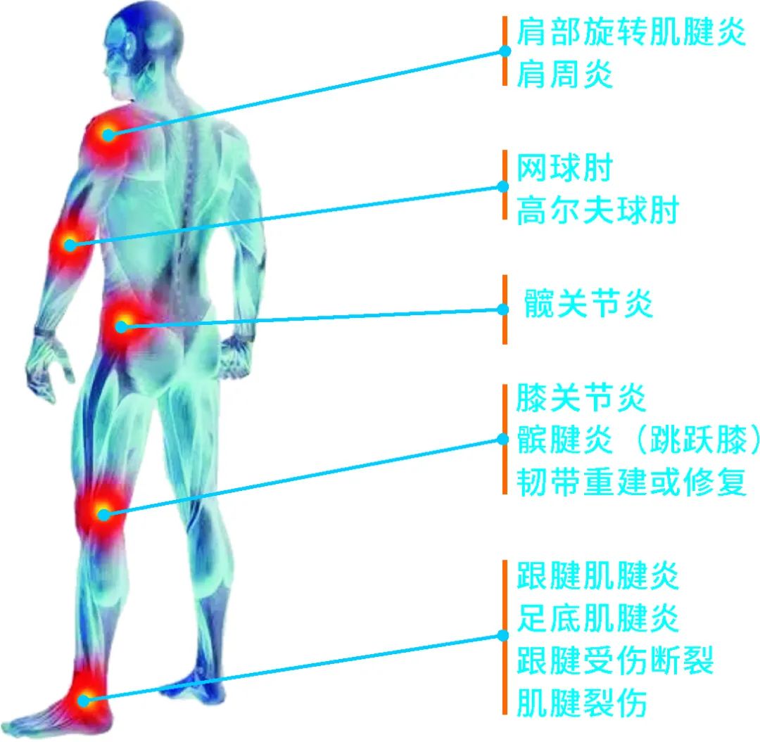 关节绿色治疗|PRP 关节修复治疗术 关节绿色治疗|PRP 关节修复治疗术