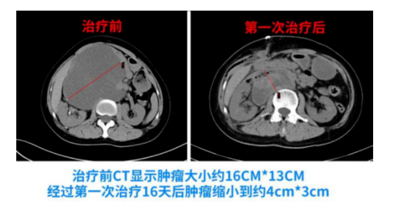 患者实例 ｜7年腹腔巨瘤终于摘除！