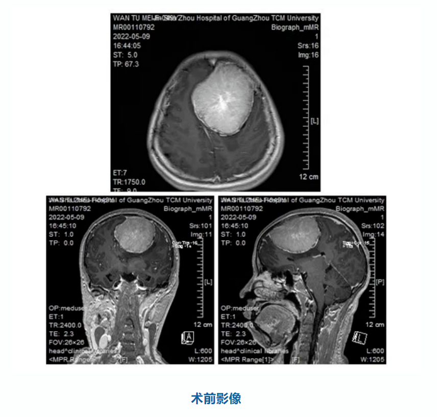 广州中医药大学金沙洲医院神经医学高难度脑膜瘤手术圆满成功! 广州中医药大学金沙洲医院神经医学高难度脑膜瘤手术圆满成功!