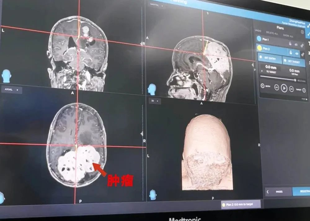 病例分享|金沙洲医院神经导航协助专家开展巨大脑膜瘤手术! 病例分享|金沙洲医院神经导航协助专家开展巨大脑膜瘤手术!