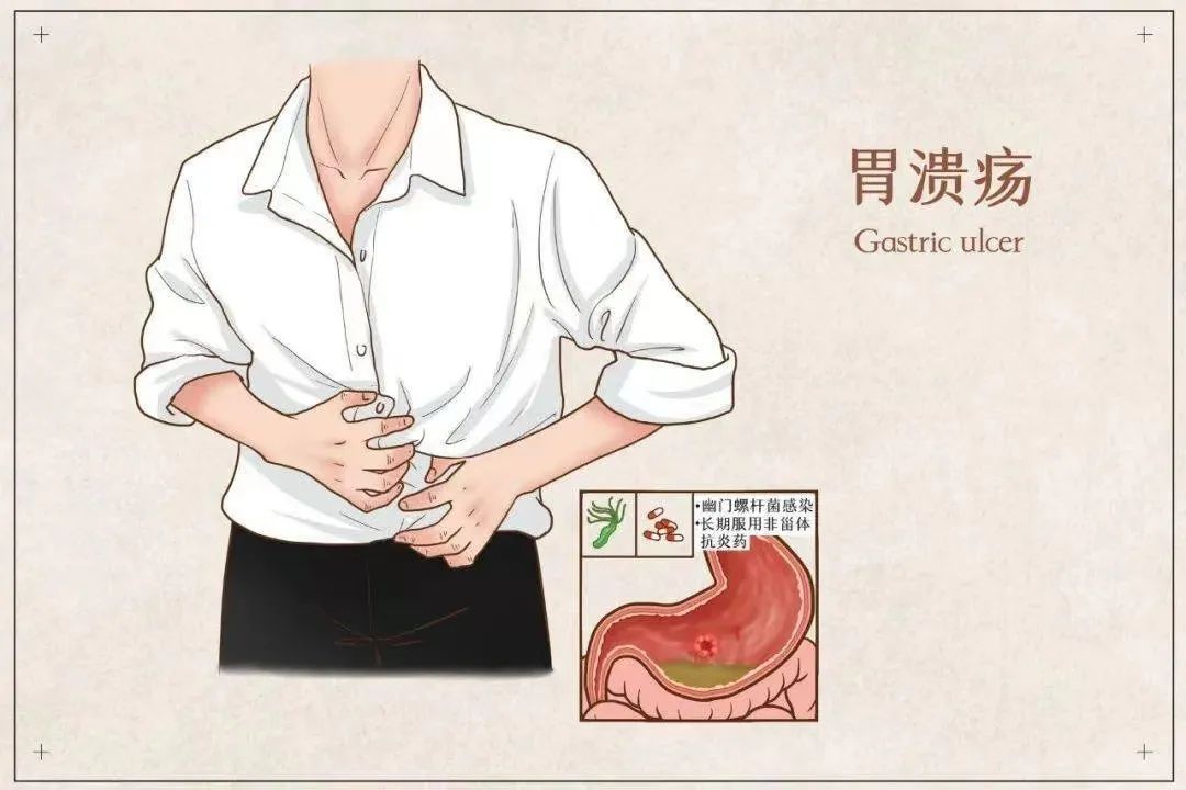 胃溃疡的护理,您需要了解这些! 胃溃疡的护理,您需要了解这些!