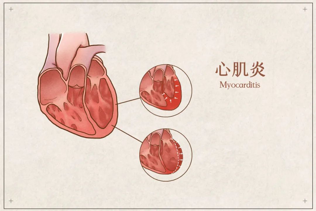 新冠感染后警惕心肌损伤，这个指标很重要！