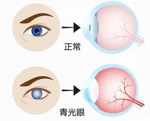 世界青光眼日|关注青光眼:共识保视野,指南护光明 世界青光眼日|关注青光眼:共识保视野,指南护光明