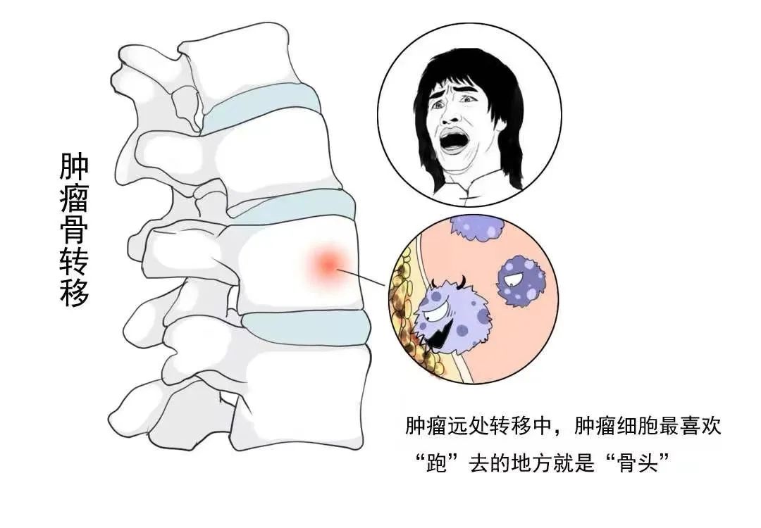发现骨转移癌莫惊慌! 发现骨转移癌莫惊慌!
