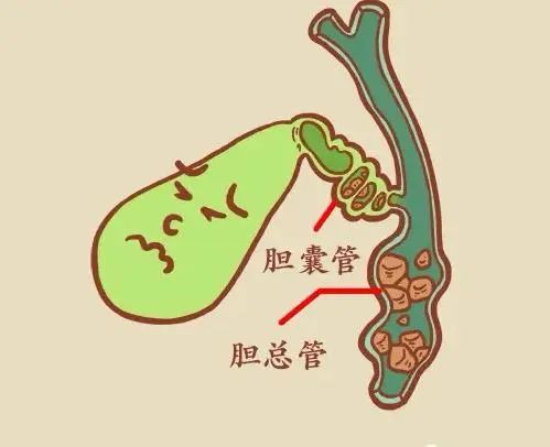 治疗慢性胆囊炎合并胆囊结石,5个药物您一定要知道 治疗慢性胆囊炎合并胆囊结石,5个药物您一定要知道