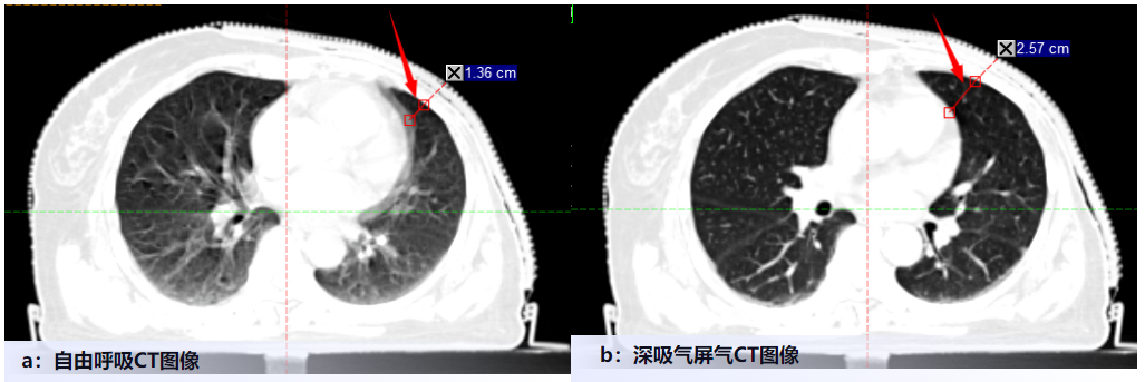 乳腺癌DIBH治疗之呼吸“随心”,不伤心 乳腺癌DIBH治疗之呼吸“随心”,不伤心
