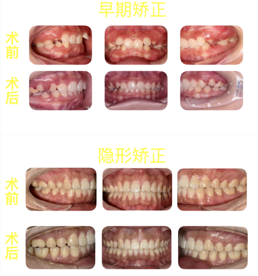 暑期正畸正当时,这一份正畸攻略请查收~ 暑期正畸正当时,这一份正畸攻略请查收~