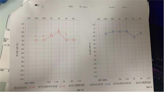 病例分享|耳内镜手术,精准微创治疗耳科疾患 病例分享|耳内镜手术,精准微创治疗耳科疾患