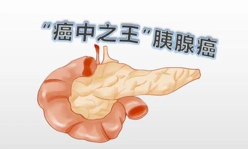 “癌中之王”怎么做可以有效的减少不适呢? “癌中之王”怎么做可以有效的减少不适呢?