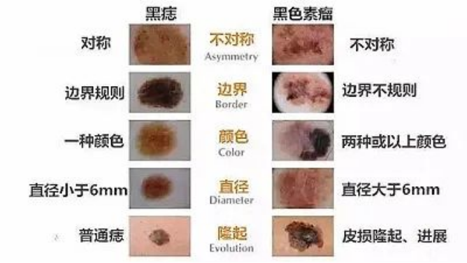 大众科普|“癌王”恶性黑色素瘤到底是什么? 大众科普|“癌王”恶性黑色素瘤到底是什么?