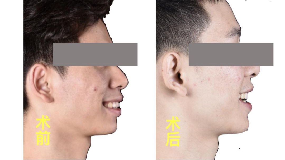 正畸科普 | “整牙”不戴“钢箍”,隐形矫正让你悄悄变美! 正畸科普 | “整牙”不戴“钢箍”,隐形矫正让你悄悄变美!