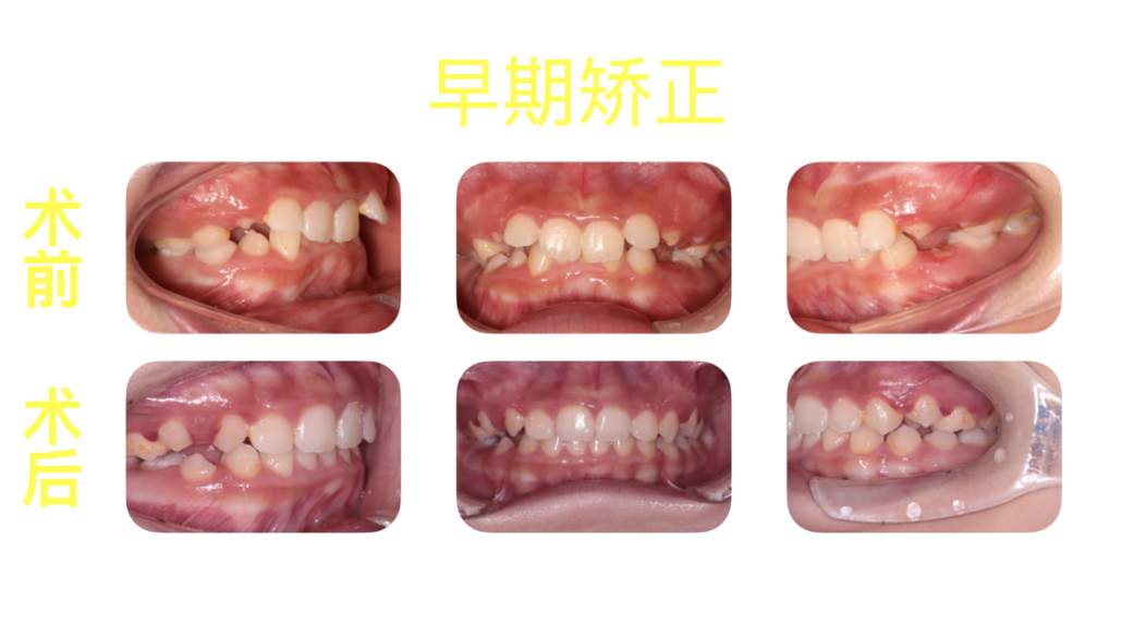 正畸科普 | “整牙”不戴“钢箍”,隐形矫正让你悄悄变美! 正畸科普 | “整牙”不戴“钢箍”,隐形矫正让你悄悄变美!