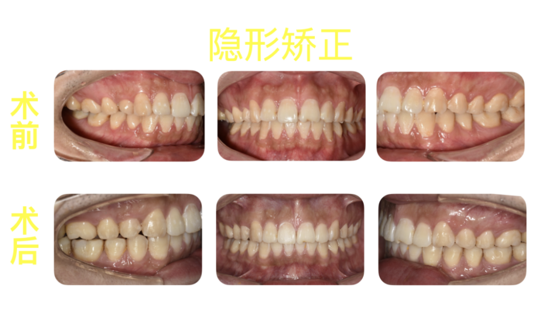 正畸科普 | “整牙”不戴“钢箍”,隐形矫正让你悄悄变美! 正畸科普 | “整牙”不戴“钢箍”,隐形矫正让你悄悄变美!