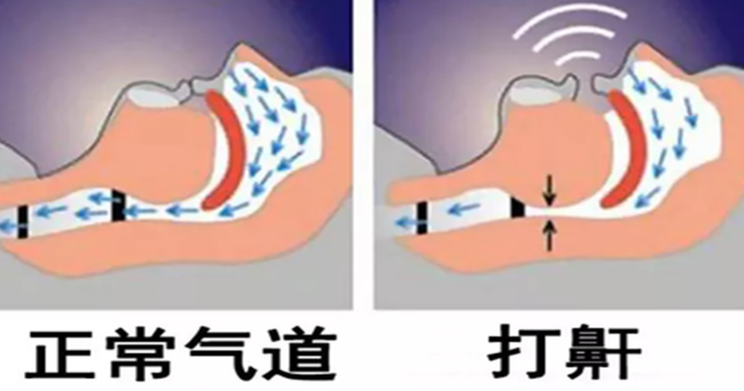 大众科普|打呼噜是睡得香吗?警惕阻塞性睡眠呼吸暂停低通气综合征! 大众科普|打呼噜是睡得香吗?警惕阻塞性睡眠呼吸暂停低通气综合征!