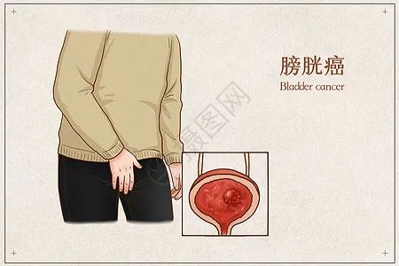 营养课堂|膀胱癌饮食知多少? 营养课堂|膀胱癌饮食知多少?