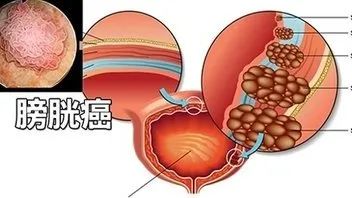 护理园地|膀胱癌的护理你get多少? 护理园地|膀胱癌的护理你get多少?