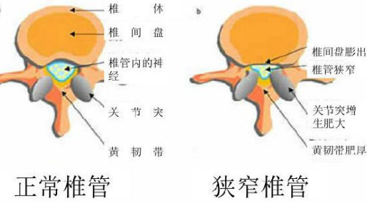 大众科普|腰腿疼痛,小心腰椎管狭窄! 大众科普|腰腿疼痛,小心腰椎管狭窄!