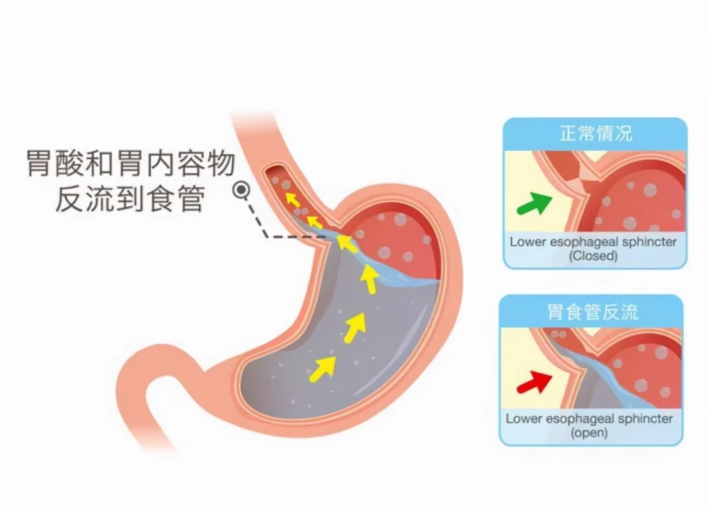 护理园地|日常如何有效护理胃食管反流? 护理园地|日常如何有效护理胃食管反流?