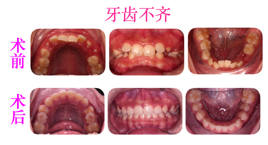 儿童早期矫正 | 孩子必须『换完牙』才能做矫正? 儿童早期矫正 | 孩子必须『换完牙』才能做矫正?