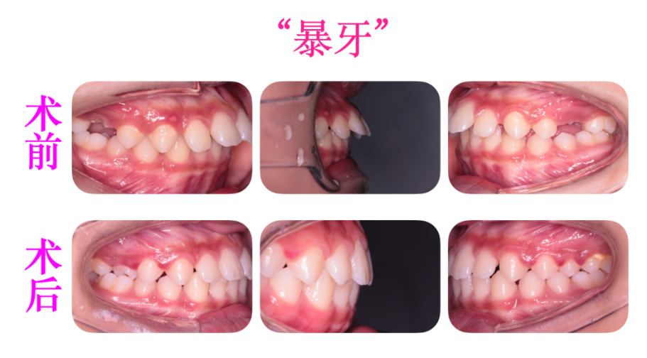 儿童早期矫正 | 孩子必须『换完牙』才能做矫正? 儿童早期矫正 | 孩子必须『换完牙』才能做矫正?