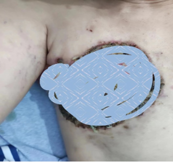 肿瘤医生忠告:按摩乳房肿块要小心!!! 肿瘤医生忠告:按摩乳房肿块要小心!!!
