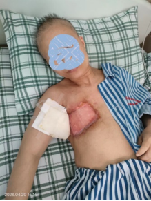 肿瘤医生忠告:按摩乳房肿块要小心!!! 肿瘤医生忠告:按摩乳房肿块要小心!!!