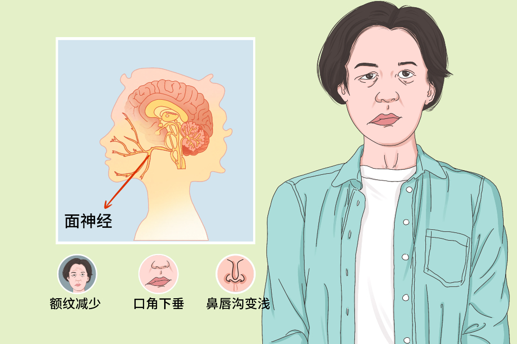 大众科普|一觉醒来口角歪了？警惕面神经炎！