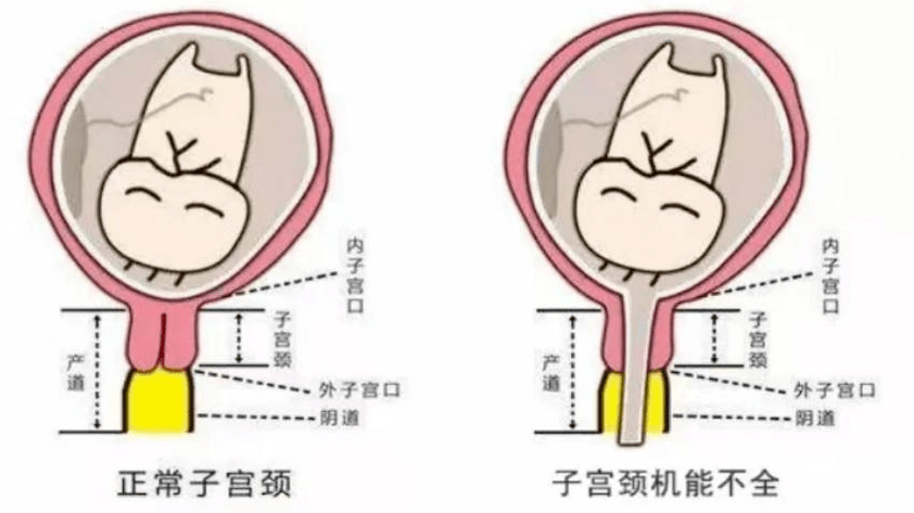 大众科普|宫颈机能不全--孕期的噩梦 大众科普|宫颈机能不全--孕期的噩梦
