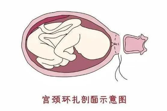 大众科普|宫颈机能不全--孕期的噩梦 大众科普|宫颈机能不全--孕期的噩梦