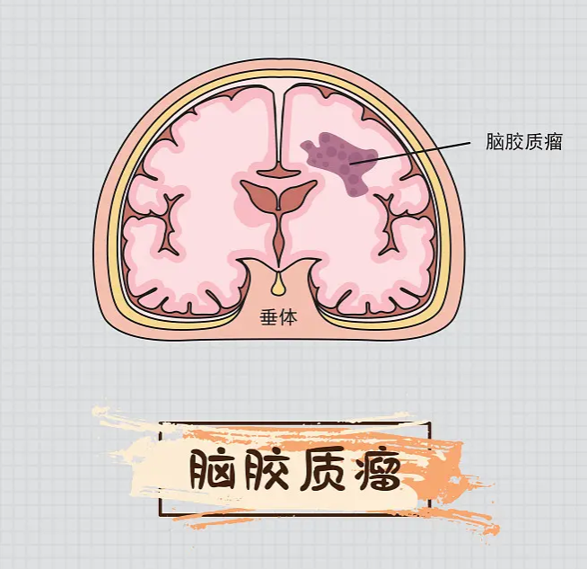 大众科普|一起了解“大脑杀手”--脑胶质瘤 大众科普|一起了解“大脑杀手”--脑胶质瘤