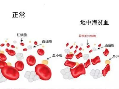 营养课堂|地中海贫血饮食禁忌 营养课堂|地中海贫血饮食禁忌
