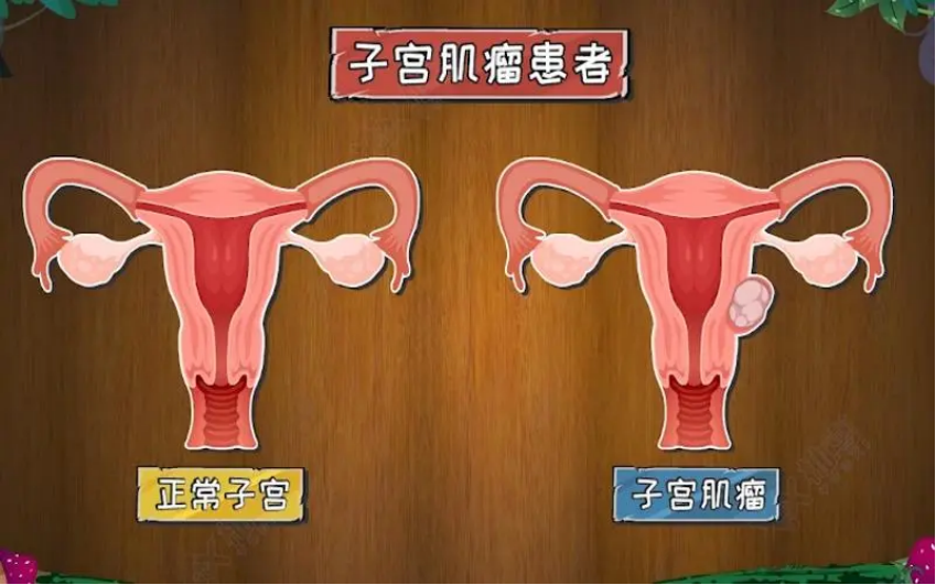 大众科普|浅谈大众熟知的子宫肌瘤 大众科普|浅谈大众熟知的子宫肌瘤