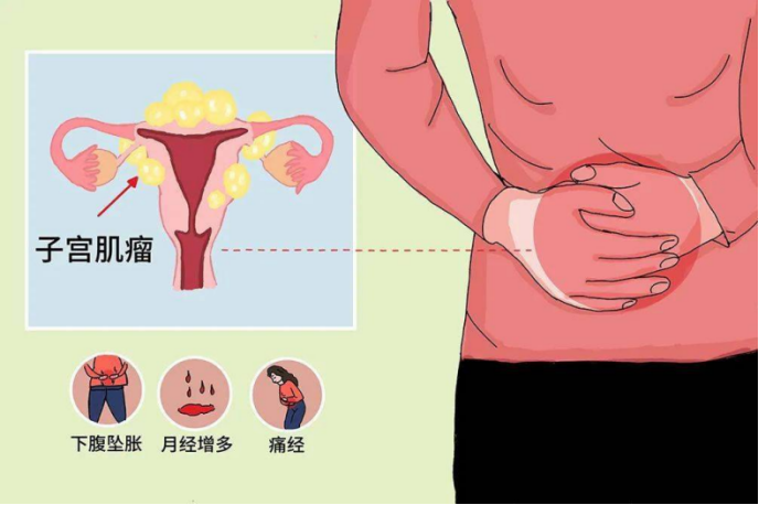 大众科普|浅谈大众熟知的子宫肌瘤 大众科普|浅谈大众熟知的子宫肌瘤
