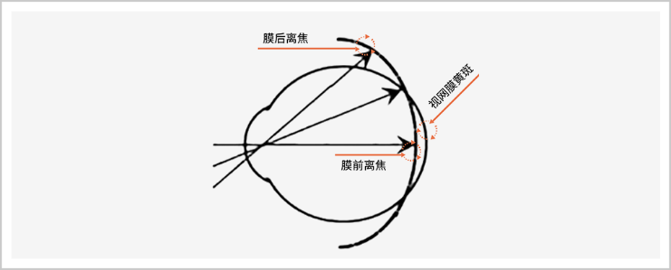 大众科普|离焦眼镜防控近视 大众科普|离焦眼镜防控近视