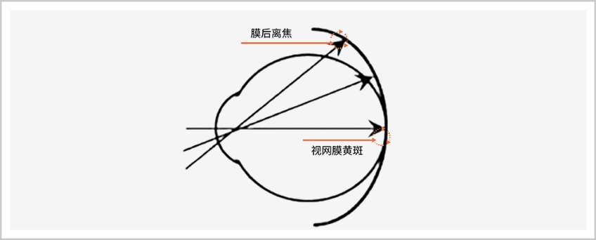 大众科普|离焦眼镜防控近视 大众科普|离焦眼镜防控近视