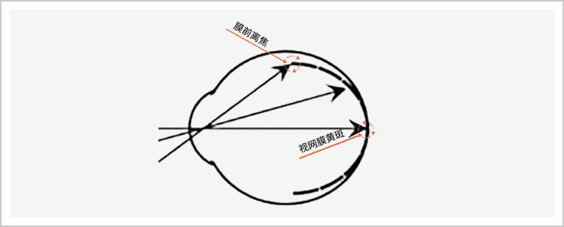 大众科普|离焦眼镜防控近视 大众科普|离焦眼镜防控近视