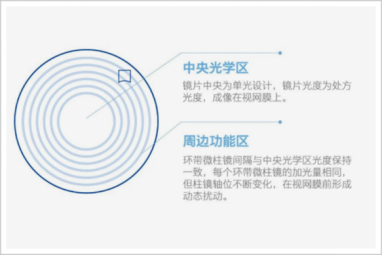 大众科普|离焦眼镜防控近视 大众科普|离焦眼镜防控近视