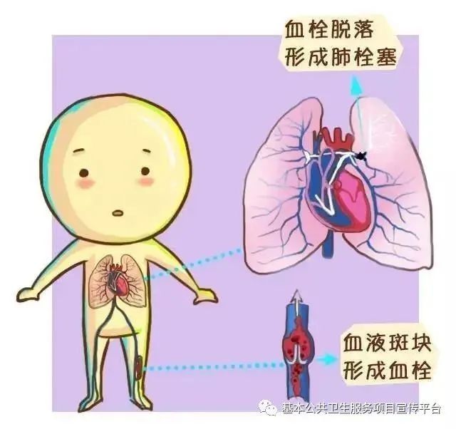 世界血栓日——栓不住 动起来 世界血栓日——栓不住 动起来